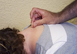 Chiropractic Acupuncture